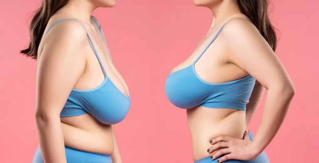 Breast Lift Surgery Details
